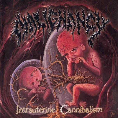 Malignancy: "Intrauterine Cannibalism" – 1999